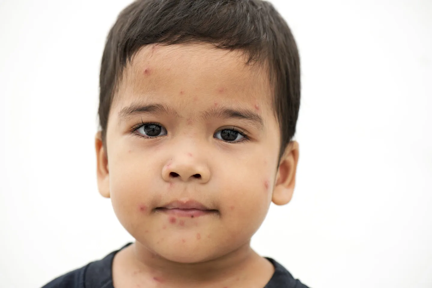 Measles is highly contagious. Here’s how to protect yourself